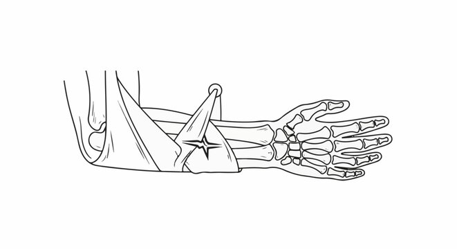 Anatomical drawing of a human arm with a sling, showing bones