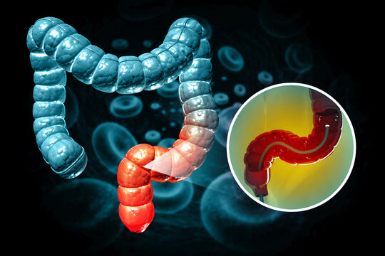 colon cancer. colonoscopy in the colon. polyp removal. 3d illustration