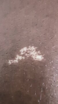  view of uneven depigmented area on human surface showing contrast, detail, and organic patterning. Dermatological concept with natural variation and textured appearance.