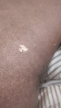 Macro view of uneven depigmented area on human surface showing contrast, detail, and organic patterning. Dermatological concept with natural variation and textured appearance.