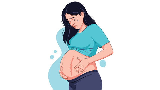 Sad pregnant woman looking at her belly and touching red stretch marks while feeling emotional during pregnancy.