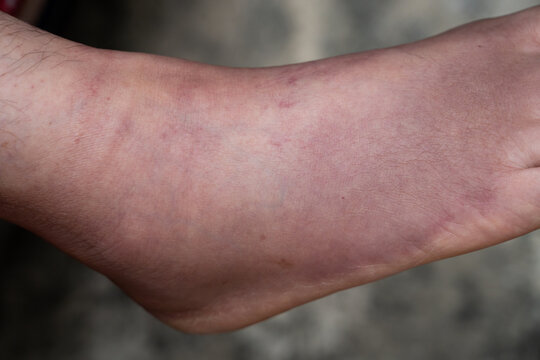 Swollen Foot After Cast Removal of Metatarsal Fracture