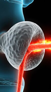Close-up Animation of a Herniated Disc Compressing a Spinal Nerve Root Causing Sciatica Pain