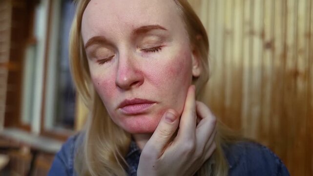 Rosacea and couperosis of the skin. The girl suffers from redness on her cheeks or sunburn symptoms. Redness and capillary mesh are visible on the face. Vascular surgery and dermatology