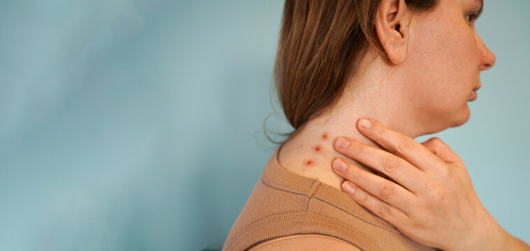 painful of inflamed damage acne on neck