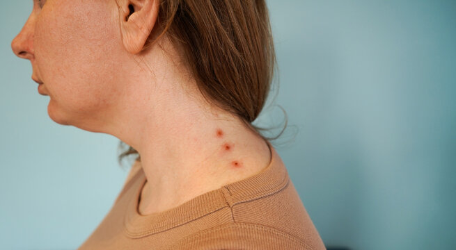 Woman with inflamed acne on her neck and jawline area. Problem skin treatment concept. Cosmetology concept.
