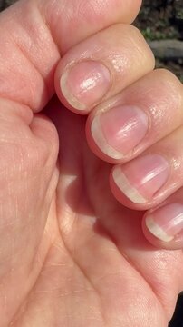 wavy deformation of the nail close-up, microtraumas, improper care of the nail plate