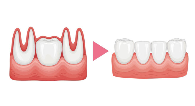 Detailed illustration showcasing the dental bridge procedure, demonstrating how missing teeth are replaced to restore oral health, function, and aesthetics effectively