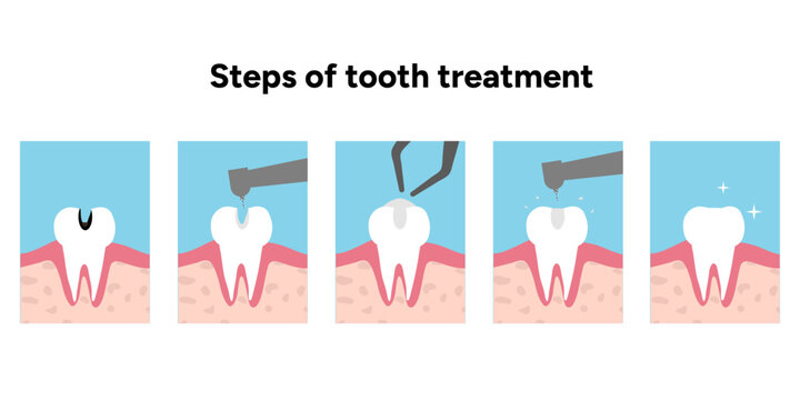 Hand drawn illustration set showing tooth anatomy and step by step dental treatment. Clear and educational composition featuring tooth structure, enamel, dentin, pulp, and treatment stages