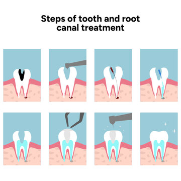 Hand drawn illustration set showing tooth anatomy and step by step dental treatment, including root canal procedure. Educational and detailed composition internal tooth structure, roots, nerve 