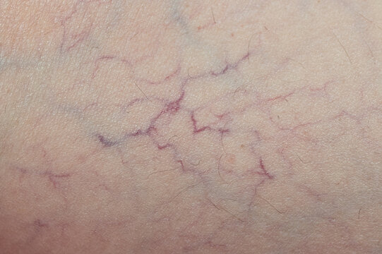 A close-up image for medical purposes showing broken capillaries or varicose veins on human skin.