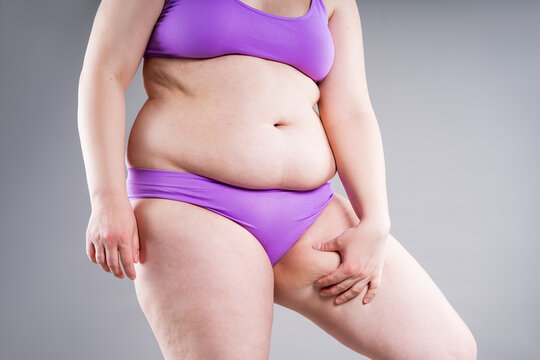 Overweight woman thigh to show cellulite. Concept of anti-cellulite treatment and weight loss