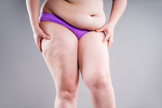 Overweight woman thigh to show cellulite. Concept of anti-cellulite treatment and weight loss