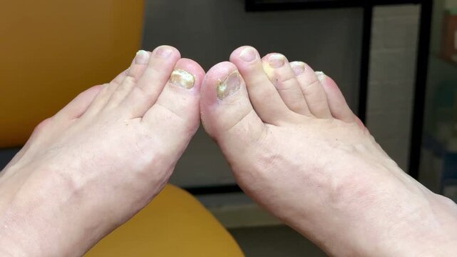 Onychomycosis. A dangerous fungal infection of the toenails of a person sitting in a doctor's examination chair. Disease and detachment of the nail plate. Close-up.