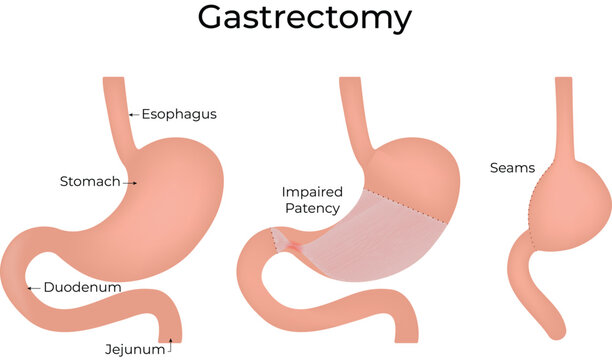 Gastrectomy Surgical Procedure Diagram