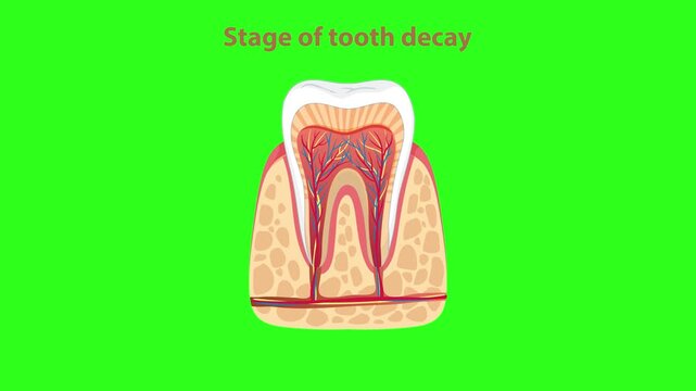 Educational video showing stage of tooth decay from normal tooth to advanced decay in pulp on green screen background.