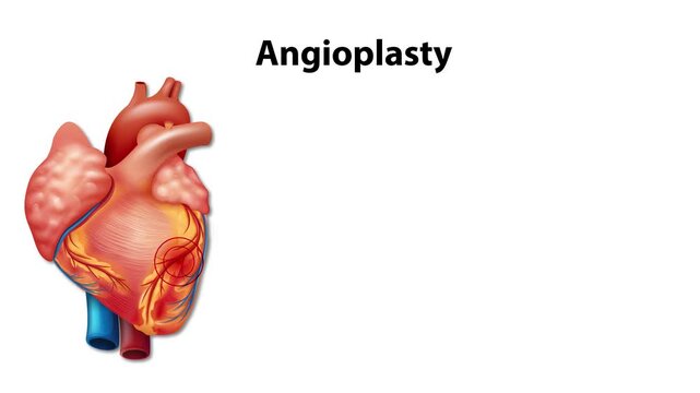 Angioplasty medical procedure animation showing heart artery blockage and stent placement.