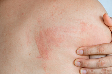 Fototapeta premium Close up of a man with a red skin rash and inflammation on his back. A person scratching an itchy allergic reaction, eczema, or dermatitis on the body. Concept of healthcare and dermatology, urticaria