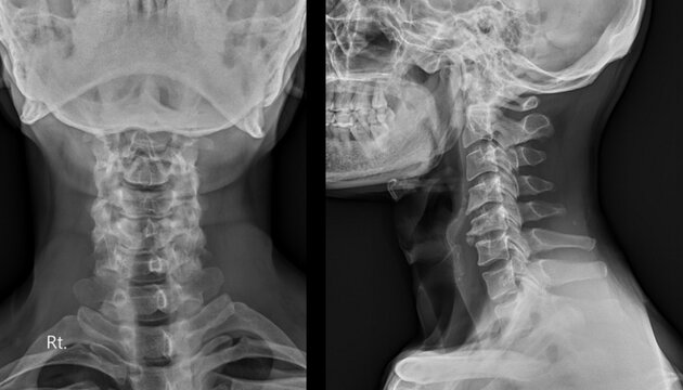 Cervical Spine X-ray Showing Spondylosis and Degenerative Changes in Neck Vertebrae.