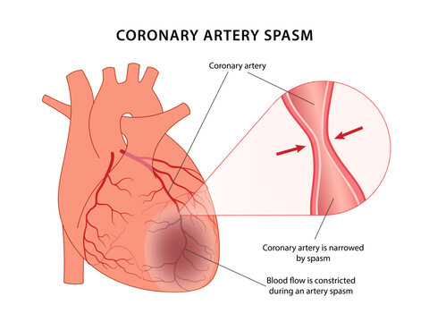 Coronary artery spasm. Medical illustration of coronary artery spasm. Vector illustration in flat style isolated over white background