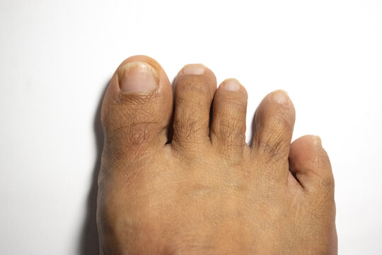 Close-up of a human foot against a plain white background. Finger-like toes show natural texture and slight discoloration. Minimalist composition draws attention to foot details. Suitable for medical