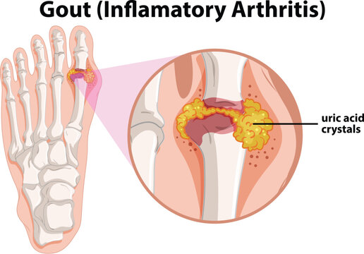 Gout Inflammatory Arthritis with Uric Acid Crystal Buildup in the Foot Joint