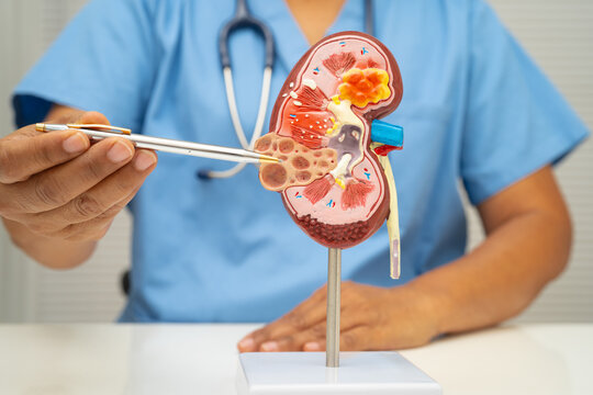 Chronic kidney disease, doctor with model for treatment urinary system, urology, Estimated glomerular filtration rate eGFR.