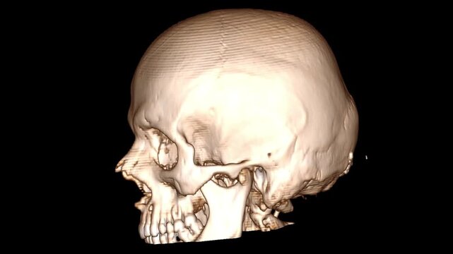 3D CT Reconstruction of Human Skull with VP Shunt for Brain Tumor. Lateral view of a 3D medical imaging reconstruction showing a ventricular-peritoneal shunt placement in the right pariet