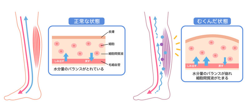 むくみの構造　水分量のバランス　断面図
