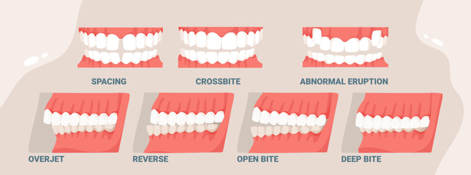 Dental bite types including spacing, crossbite, overjet, reverse, open bite, deep bite, and abnormal eruption shown for orthodontic and dental education vector illustration
