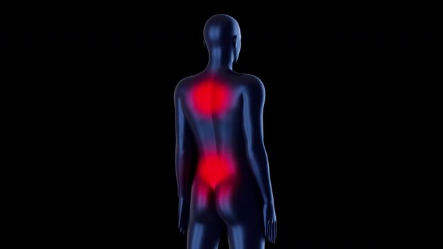 3D animation showing multiple red pain zones on upper and lower back. Conceptualizes complex spinal issues, musculoskeletal disorders or widespread back inflammation.