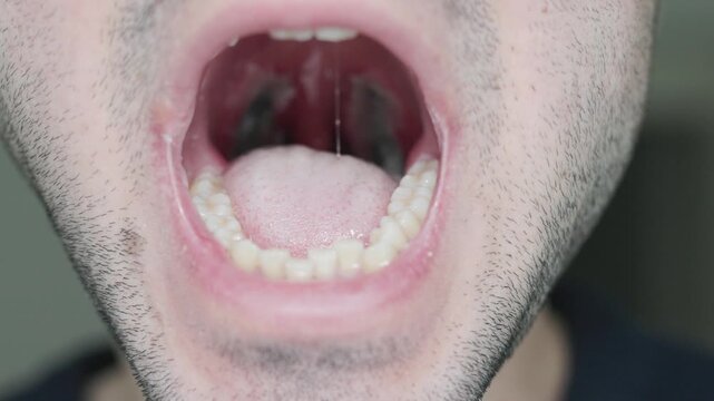 Close-up of Throat and Tonsil Bed Recovery After Tonsillectomy Surgery