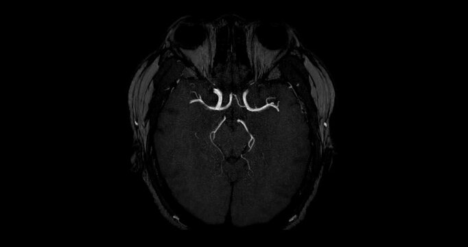 Magnetic Resonance Angiography (MRA) of the human brain shown in multiplanar grayscale views. Displays normal cerebral blood vessels for clinical diagnosis.