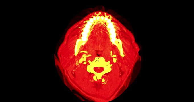 Detailed axial cross-section animation of a human head and neck CT scan. Visualized with an orange and red heatmap highlighting bone structure and cerebral anatomy.