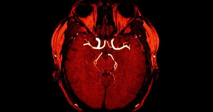 Magnetic Resonance Angiography (MRA) of the human brain shown in multiplanar grayscale views. Displays normal cerebral blood vessels for clinical diagnosis.