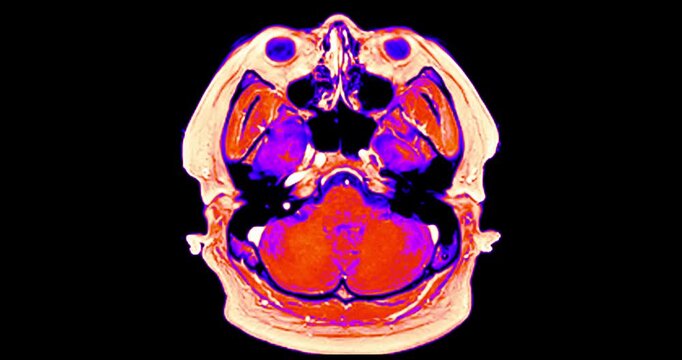 High-contrast grayscale Magnetic Resonance Imaging (MRI) in axial view. Clearly visualizes the intricate vascular network of the human brain.
