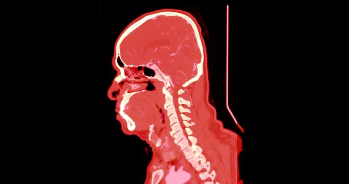 Animated coronal Computed Tomography Angiography (CTA) scan of a human head. Features vibrant orange thermal color mapping for medical or scientific visuals.