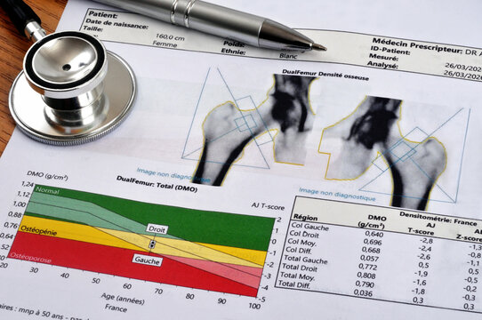 R&eacute;sultat d'une ost&eacute;odensitom&eacute;trie en langue fran&ccedil;aise avec un st&eacute;thoscope et un stylo en gros plan