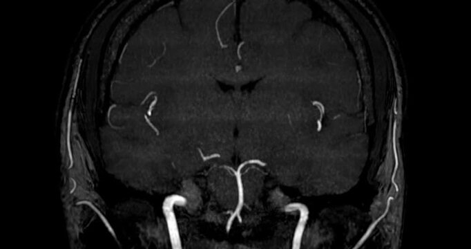 Magnetic Resonance Angiography (MRA) of the human brain shown in multiplanar grayscale views. Displays normal cerebral blood vessels for clinical diagnosis.