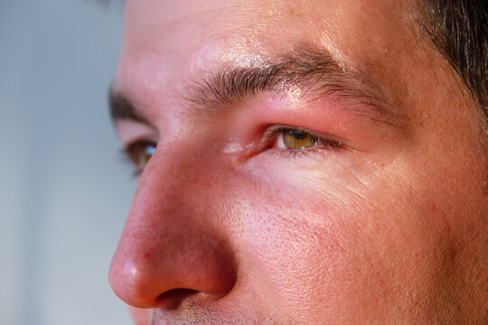 Allergic eye swelling after bee sting, eyelid redness, severe puffiness, danger of infection, urgent help needed, other causes include trauma and conjunctivitis.