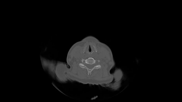 Professional radiological head scan showcasing the internal anatomy of the brain through high-contrast digital medical technology.