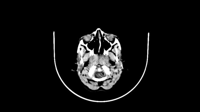 Advanced computed tomography imaging of the skull and brain tissue used in neurosurgery and radiological clinical examinations.