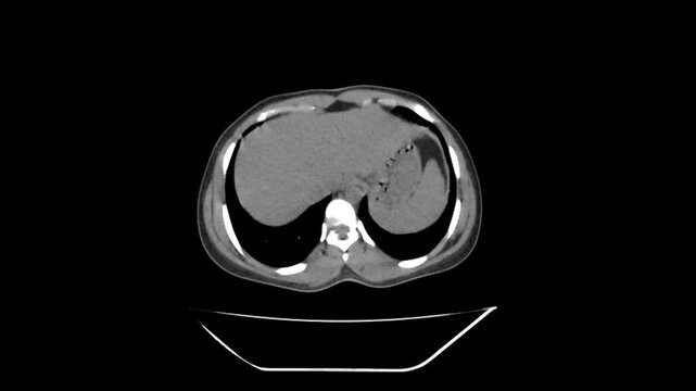 Detailed CT KUB scan showing a high-resolution cross-sectional view of the human kidneys, ureters, and bladder for medical diagnosis.