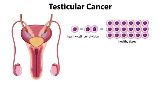 Diagram showing progression of testicular cancer from healthy cell to malignant tissue formation.