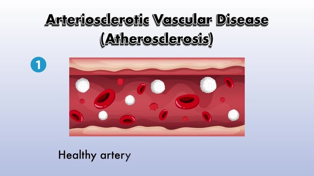 Arteriosclerotic vascular disease atherosclerosis progression from healthy artery to thrombosis animation footage.
