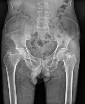 Frontal view of the human pelvic region captured via digital radiography for musculoskeletal evaluation. This clinical imaging asset is suitable for trauma care, bone density research, 