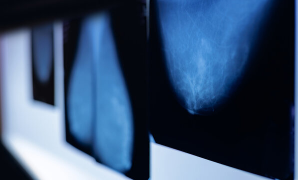 Breast mammogram tissue compressed and imaged on radiology lightbox