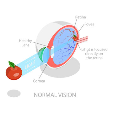 3D Isometric Flat Vector Illustration of Vision Disorder, Far-Sightedness And Near-Sightedness Anatomical Diagram. Item 3