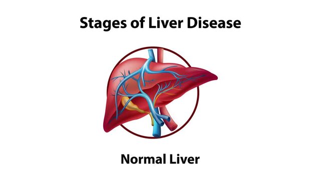 Educational animation illustrating the progressive stages of liver disease from a healthy liver to fatty liver, fibrosis, and advanced cirrhosis with detailed internal structures visible.