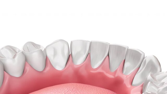3D animation of Dental surgery, dental implants